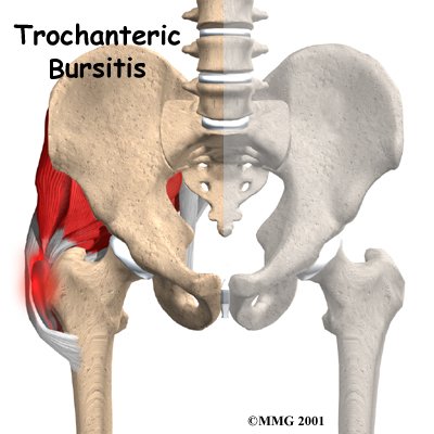 Trochanteric Bursitis Surgery