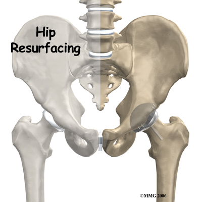 Hip Resurfacing Arthroplasty