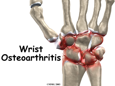 Osteoarthritis of the Wrist Joint