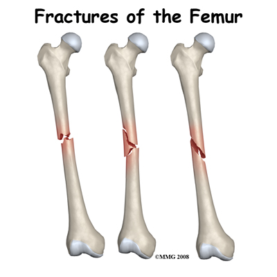 Adult Femur Fractures