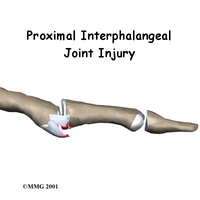 PIP Joint Injuries of the Finger